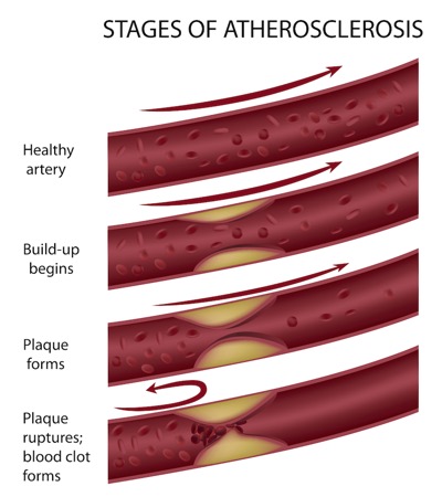 Stages of Coronary Disease