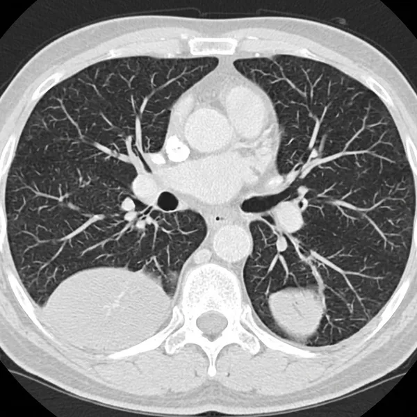 Illustration: cross-section CT slice of the chest