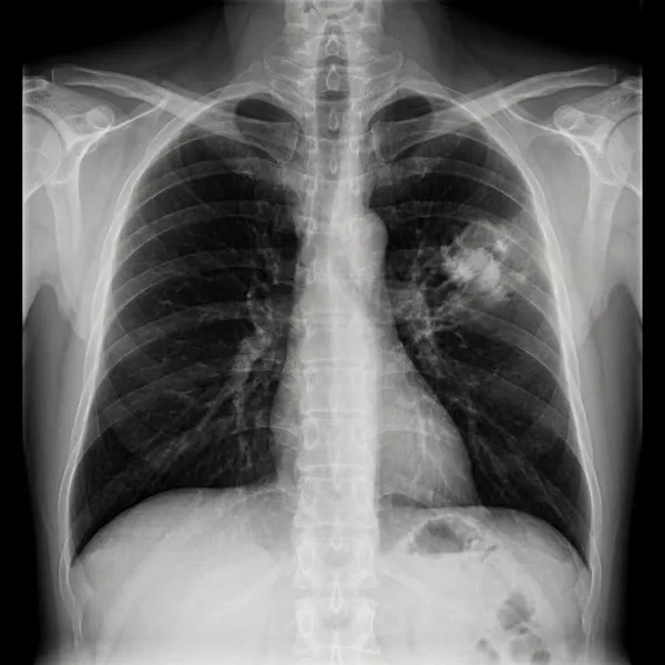 Illustration: chest X-ray with a mass in the left lung
